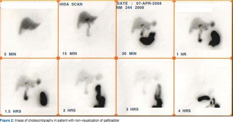 hida scan market|Cholescintigraphy .